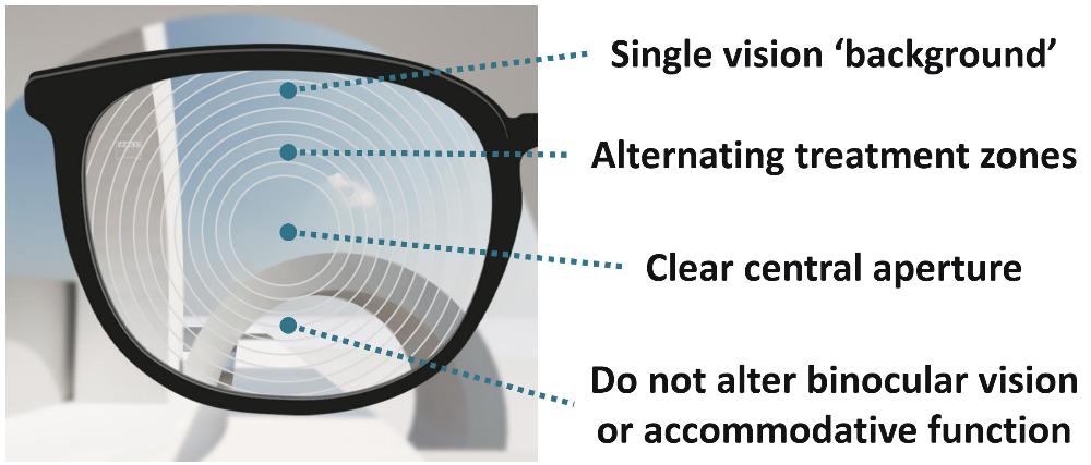 Myopia control lens diagram — treatment zones, clear central aperture